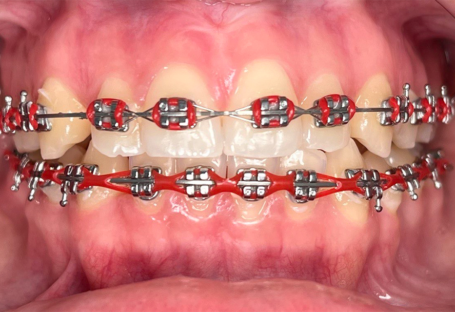 Nuestra paciente estaba muy inconforme con sus prótesis, pero, por una diabetes no controlada, no se pudo practicar la cirugía de implantes dentales.  el diseño de sonrisa con coronas de cerámicas para los dientes del sector anterior y prótesis removibles para los del posterior.